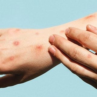 Vaiolo delle scimmie, monta la polemica