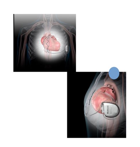 Defibrillatore di ultima generazione salva la vita ad un calciatore ventenne Defibrillatore di ultima generazione salva la vita ad un calciatore ventenne