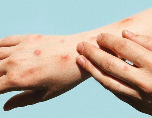 Vaiolo delle scimmie, monta la polemica