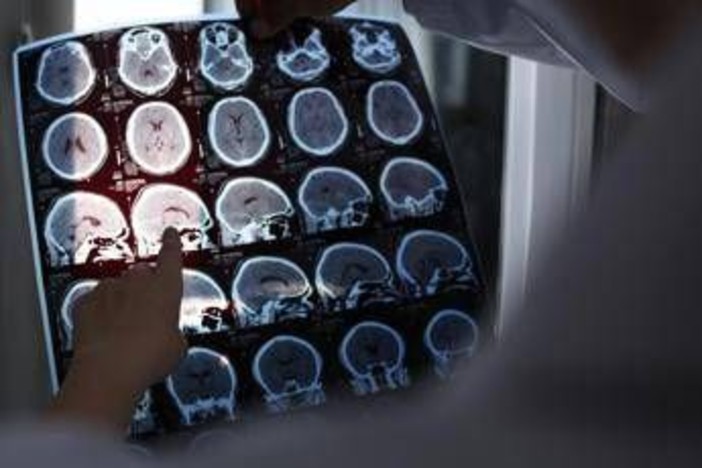 Nuove molecole e bersagli, così si evolve la terapia contro l'Alzheimer: il punto