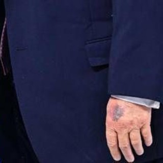 Trump e il nuovo livido sulla mano, tutte le ipotesi secondo Bassetti Trump e il nuovo livido sulla mano, tutte le ipotesi secondo Bassetti