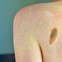 Melanoma, la firma mutazionale del cancro potrà cambiare la cura﻿