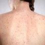 Morbillo, l'allarme dell'infettivologo Andreoni: "Casi in crescita, ricoveri frequenti negli adulti" Morbillo, l'allarme dell'infettivologo Andreoni: "Casi in crescita, ricoveri frequenti negli adulti"