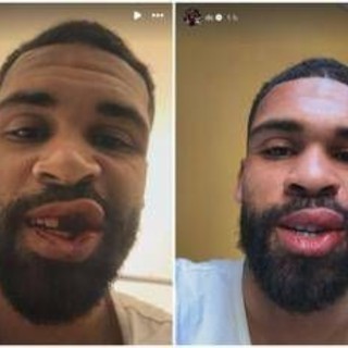 Loftus-Cheek, intervento riuscito alla mascella. E mostra foto dopo scontro in Milan-Parma