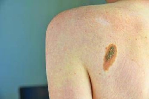 Melanoma, la firma mutazionale del cancro potrà cambiare la cura﻿