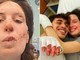 Crans-Montana, oggi dimessi due ragazzi. Eleonora Palmieri mostra le ustioni sui social