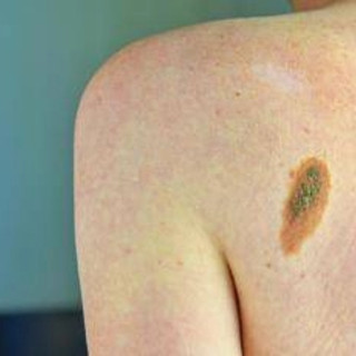 Ok Aifa a immunoterapia in fase precoce per melanoma e carcinoma polmonare